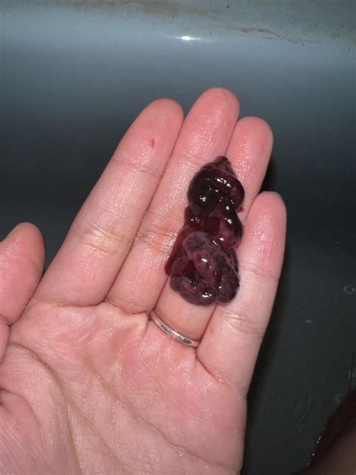 Miscarriage Pictures at 6 Weeks: Understanding, Coping, and Finding Support